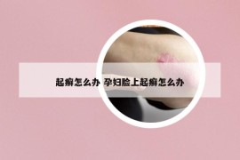 起癬怎么辦 孕婦臉上起癬怎么辦