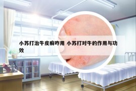 小蘇打治牛皮癬咋用 小蘇打?qū)ε５淖饔门c功效