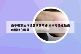南寧哪家治療銀屑病醫(yī)院好 南寧專治皮膚病的醫(yī)院在哪里