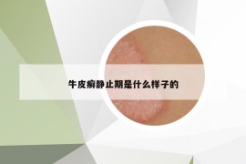 牛皮癬靜止期是什么樣子的