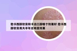 他卡西醇軟膏和卡泊三醇哪個(gè)效果好 他卡西醇軟膏用大半年無(wú)明顯效果