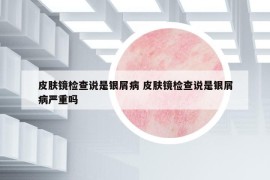 皮膚鏡檢查說是銀屑病 皮膚鏡檢查說是銀屑病嚴重嗎