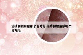 濕疹和銀屑病那個有對稱 濕疹和銀屑病哪個更難治