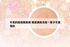 不死的癌癥銀屑病 銀屑病有沒(méi)有一輩子不復(fù)發(fā)的