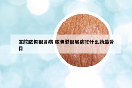掌舵膿包銀屑病 膿包型銀屑病吃什么藥最管用