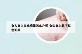 女人身上出來癬是怎么辦呢 女生身上起了紅色的癬