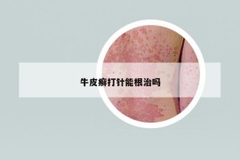 牛皮癬打針能根治嗎