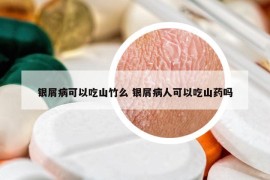 銀屑病可以吃山竹么 銀屑病人可以吃山藥嗎