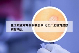 化工職業(yè)對(duì)牛皮癬的影響 化工廠上班對(duì)皮膚有影響么