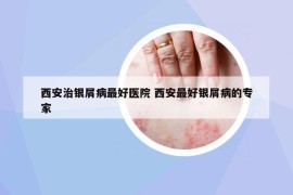 西安治銀屑病最好醫(yī)院 西安最好銀屑病的專家