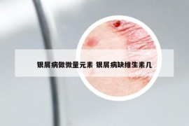銀屑病做微量元素 銀屑病缺維生素幾