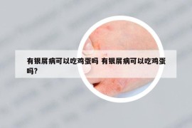 有銀屑病可以吃雞蛋嗎 有銀屑病可以吃雞蛋嗎?