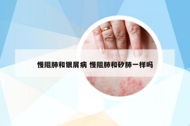 慢阻肺和銀屑病 慢阻肺和矽肺一樣嗎