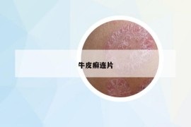 牛皮癬連片