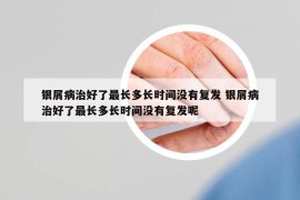 銀屑病治好了最長多長時(shí)間沒有復(fù)發(fā) 銀屑病治好了最長多長時(shí)間沒有復(fù)發(fā)呢