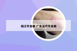 陽(yáng)江牛皮癬 廣東治療牛皮癬