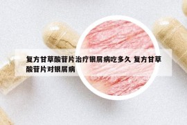 復(fù)方甘草酸苷片治療銀屑病吃多久 復(fù)方甘草酸苷片對銀屑病