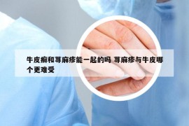 牛皮癬和蕁麻疹能一起的嗎 蕁麻疹與牛皮哪個更難受