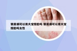 銀屑病可以用大寶擦臉嗎 銀屑病可以用大寶擦臉嗎女性