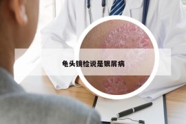 龜頭鏡檢說是銀屑病