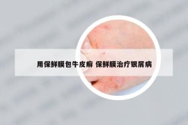 用保鮮膜包牛皮癬 保鮮膜治療銀屑病