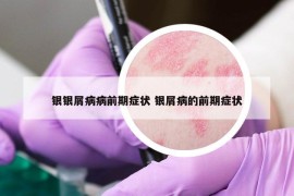 銀銀屑病病前期癥狀 銀屑病的前期癥狀