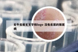 無牛皮癬無文字和logo 沒有皮屑的銀屑病
