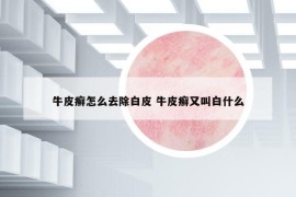 牛皮癬怎么去除白皮 牛皮癬又叫白什么