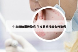 牛皮癬觸摸傳染嗎 牛皮膚癬接觸會傳染嗎