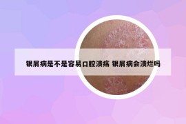 銀屑病是不是容易口腔潰瘍 銀屑病會潰爛嗎