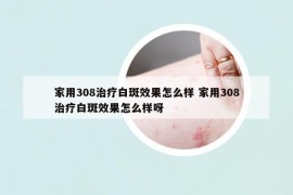 家用308治療白斑效果怎么樣 家用308治療白斑效果怎么樣呀
