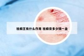 祛癬王有什么作用 祛癬膏多少錢一盒