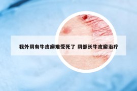 我外陰有牛皮癬難受死了 陰部長(zhǎng)牛皮廨治療