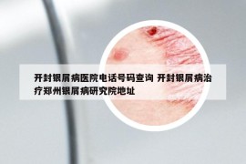 開封銀屑病醫(yī)院電話號碼查詢 開封銀屑病治療鄭州銀屑病研究院地址