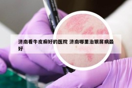 濟南看牛皮癬好的醫(yī)院 濟南哪里治銀屑病最好