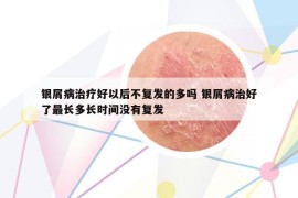 銀屑病治療好以后不復(fù)發(fā)的多嗎 銀屑病治好了最長多長時間沒有復(fù)發(fā)