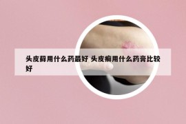頭皮蘚用什么藥最好 頭皮癬用什么藥膏比較好