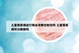 兒童銀屑病進行期必須要控制住嗎 兒童銀屑病可以斷根嗎