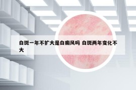白斑一年不擴(kuò)大是白癜風(fēng)嗎 白斑兩年變化不大