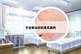 牛皮癬治好的真實(shí)案例