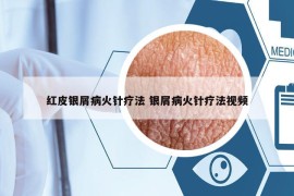 紅皮銀屑病火針療法 銀屑病火針療法視頻