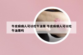 牛皮癬病人可以吃牛油果 牛皮癬病人可以吃牛油果嗎