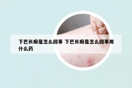 下巴長癬是怎么回事 下巴長癬是怎么回事用什么藥