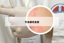 牛皮癬吃魚膠