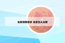 皮蘚初期癥狀 皮蘚怎么治理