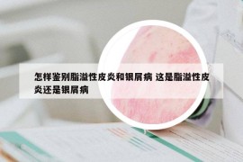 怎樣鑒別脂溢性皮炎和銀屑病 這是脂溢性皮炎還是銀屑病