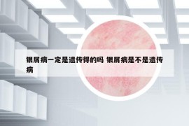 銀屑病一定是遺傳得的嗎 銀屑病是不是遺傳病
