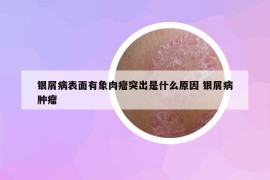 銀屑病表面有象肉瘤突出是什么原因 銀屑病腫瘤