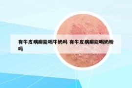 有牛皮病癬能喝牛奶嗎 有牛皮病癬能喝奶粉嗎