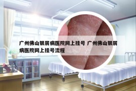 廣州佛山銀屑病醫(yī)院網(wǎng)上掛號(hào) 廣州佛山銀屑病醫(yī)院網(wǎng)上掛號(hào)流程